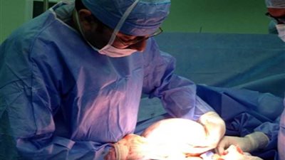 بالصور.. استئصال ورم ليفي من رحم امرأة يزن ٥ كيلوجرامات