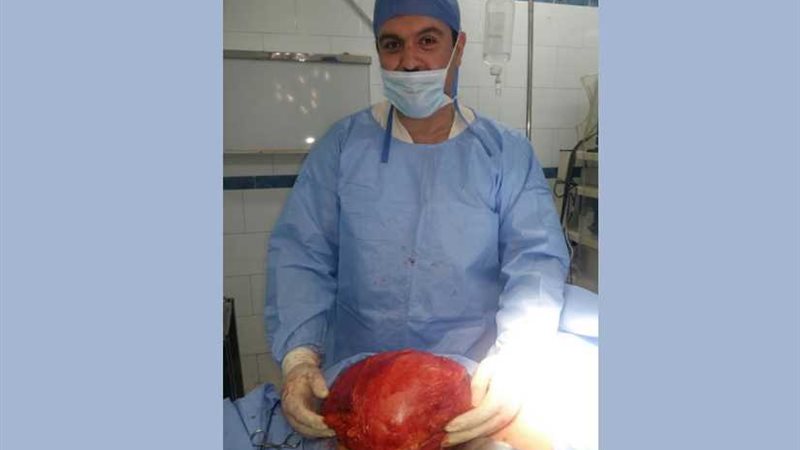 استئصال ورم يزن 15