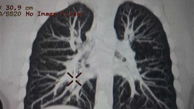 جراحة ناجحة لطفلة ابتلعت 