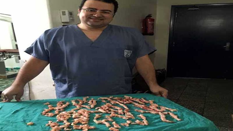 استئصال أكبر ورم