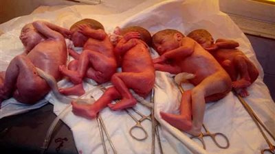 إيمان تنجب 5 توائم بمستشفى بني سويف الجامعي.. صور