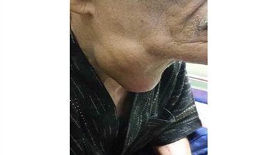 استئصال ورم من رقبة مسن بمستشفى جامعة المنصورة الدقهلية