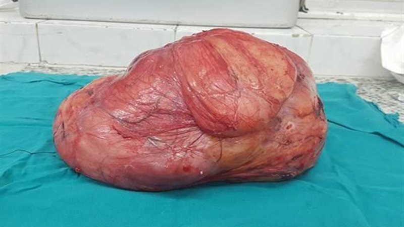 فريق طبي ينجح فى