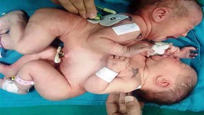 جراحة نادرة لفصل توأم ملتصق بمنطقة البطن بمستشفى 