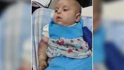 فصل الخلايا الميتة من ذراع 