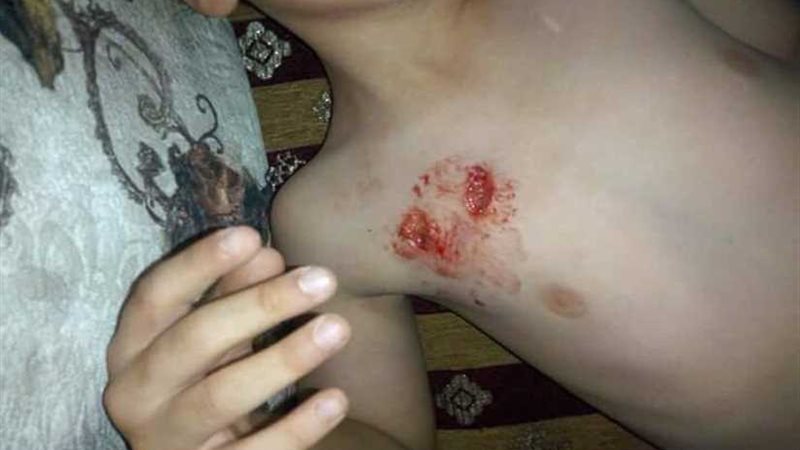 نقص مصل الكلب يغضب