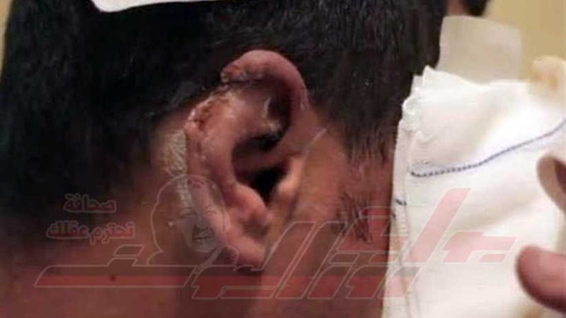 الإخوان يقطعون أذن