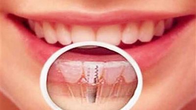 هكذا يمكن زراعة الأسنان في يوم واحد