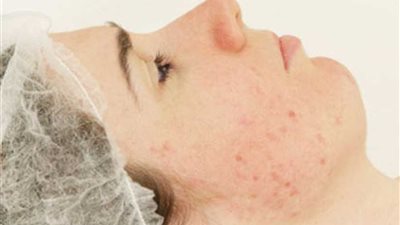 بدون تكاليف.. تخلصى من آثار حب الشباب بالمنزل