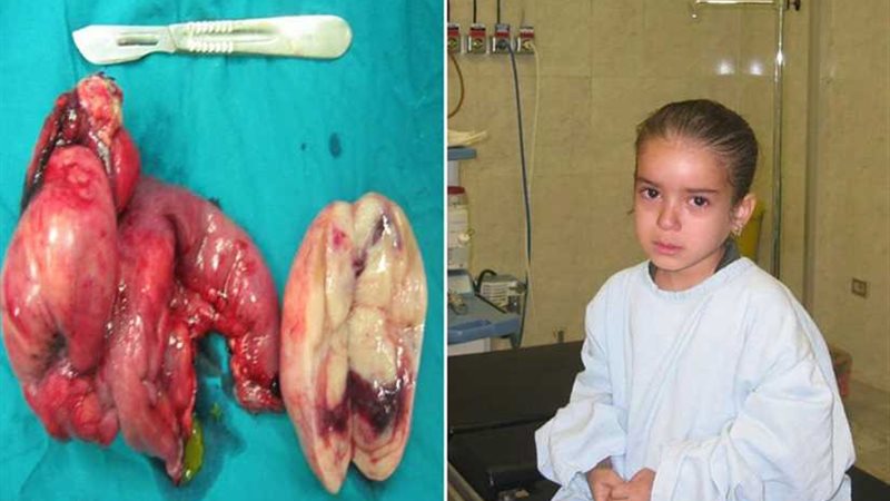 للمرة الأولى.. إزالة