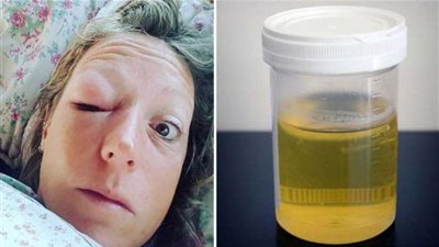 تشرب كأسين من البول يوميًا.. شاهد ماذا حدث؟