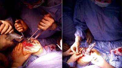 إجراء ثالث عملية تغيير مفصل كامل بنجاح بمستشفي الزقازيق العام