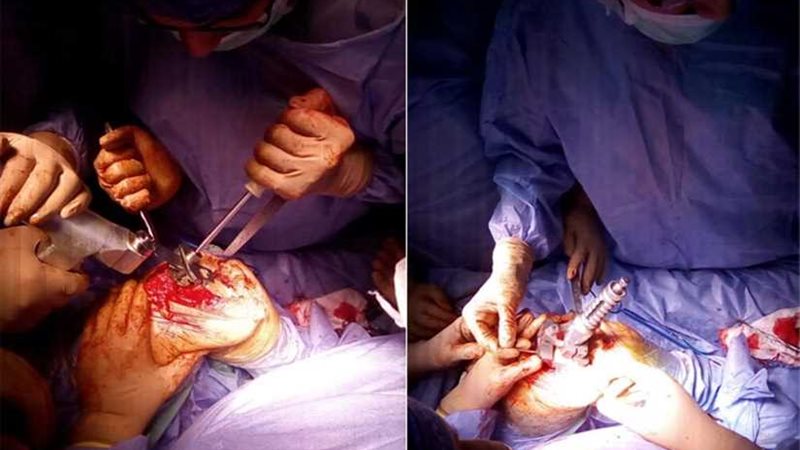 إجراء ثالث عملية