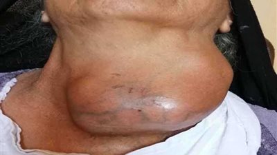 جراحة نادرة لاستئصال تضخم بالغدة الدرقية لمسنة ببني سويف