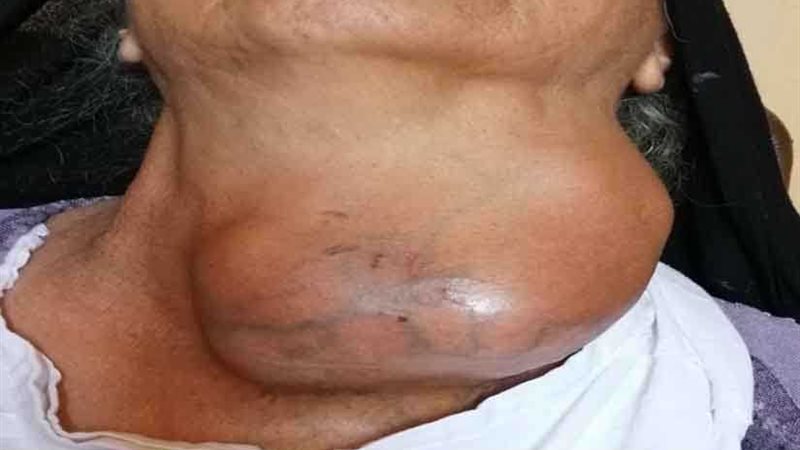 جراحة نادرة لاستئصال