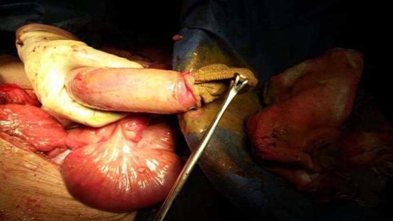 استخراج فوطة جراحية