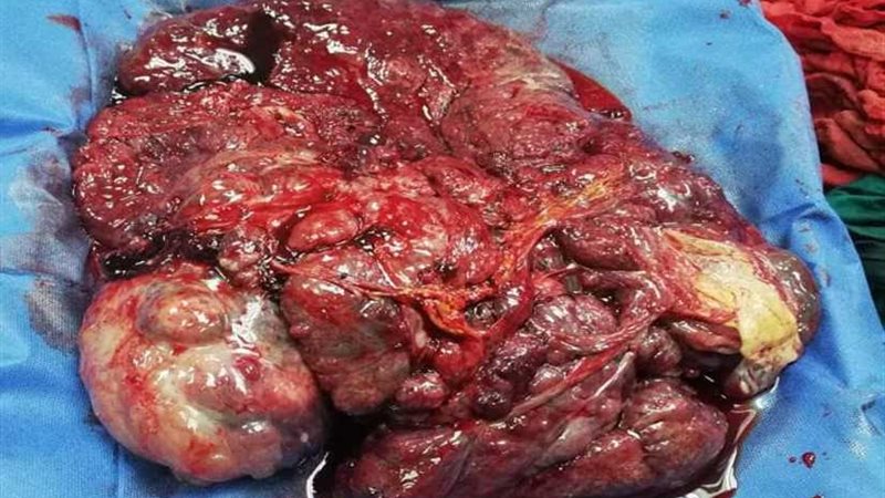 إزالة ورم ١١ كيلو