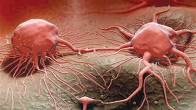 هل السرطان مرض معدٍ؟.. أخصائي يُجيب‎