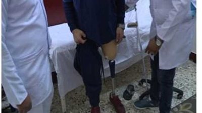 قطاع السجون يوفر أطرافًا صناعية لنزلاء بسجون برج العرب بالإسكندرية