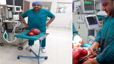 أورام طنطا يستأصل ورمًا وزنه 8 كجم من رحم سيدة