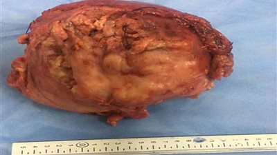 استئصال ورم سرطاني 7كجم بمثانة مريض بأسيوط