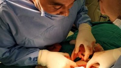 نجاح عمليات استئصال أورام بأحجام غير طبيعية بمستشفي مصر للطيران