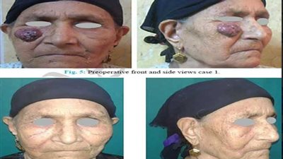 أمل جديد لمرضى أورام الوجه ينطلق من جراحات التجميل بطب طنطا