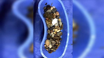 فريق طبي ينجح في استخراج زلط وسيراميك من أمعاء مريض بأسيوط