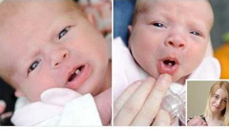 ولادة طفلة بـ سن