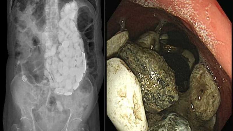 استخراج 2كيلو حجارة