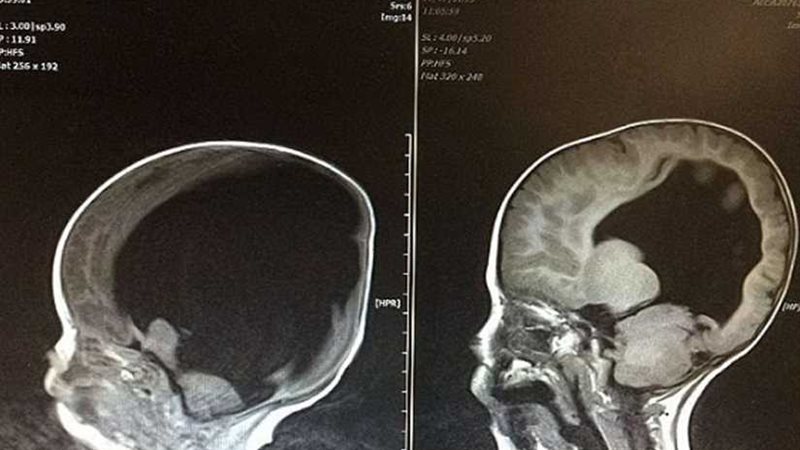 ولد من دون دماغ وبعد