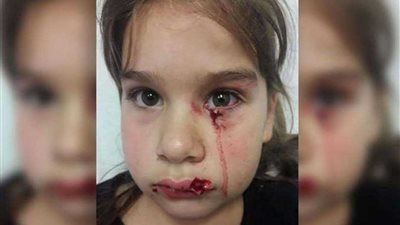 كلب يهاجم طفلة.. ووالدتها تطلب 20 مليونًا تعويضاً