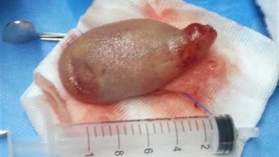 استئصال ورم دموي ليفي من قاع الجمجمة لطفل بالتأمين الصحي ببنها