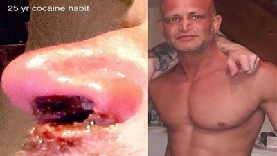 تساقط لحم الأنف لـ