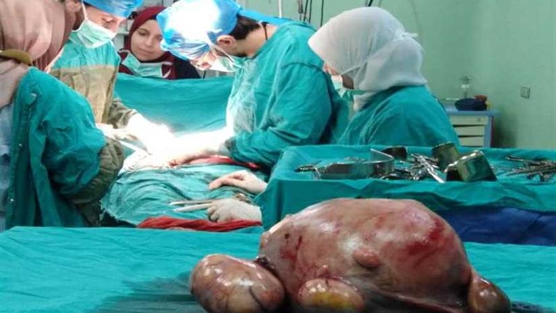 استئصال ورم يزن 20