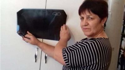 بعد 23 عامًا من إجرائها عملية قيصرية..امرأة تكتشف مقصًا في بطنها (صور)