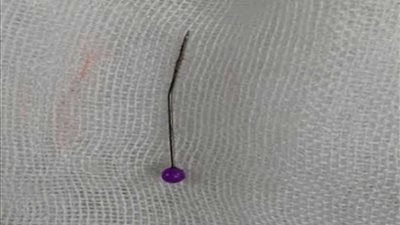 استخراج دبوس من رئة مواطن بمستشفى المنصورة الدولي