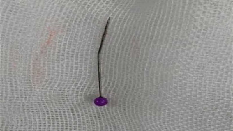 استخراج دبوس من رئة