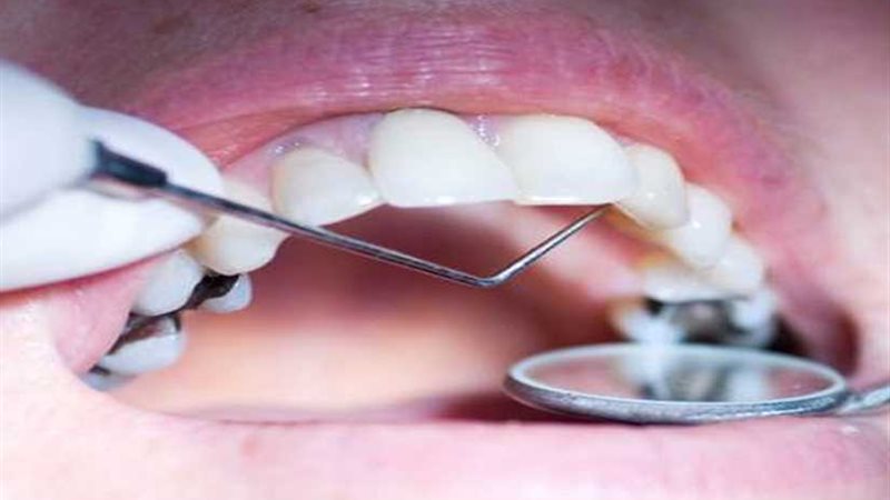 كبسولة لحماية أسنان