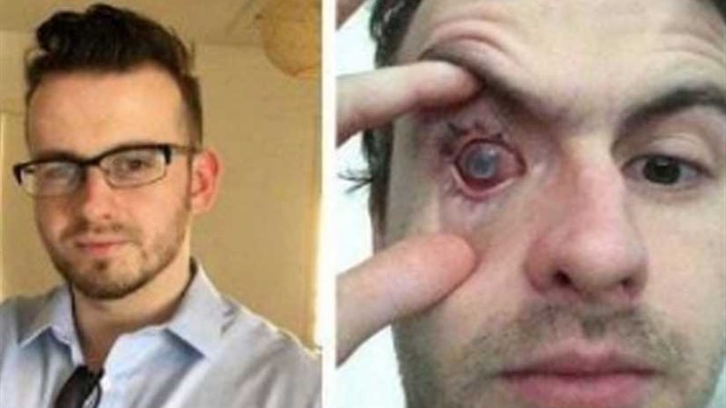 العدسات اللاصقة تتلف