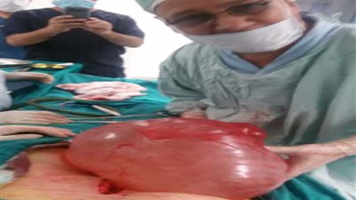 استئصال ورم 7 كيلو من بطن مريضة بمستشفى المعلمين