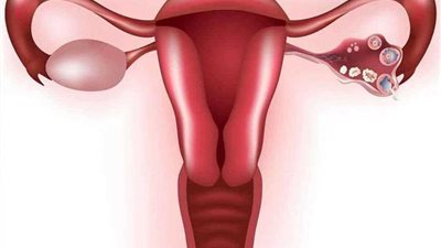 تعرف على أسباب وأعراض مرض تكيس المبيضين