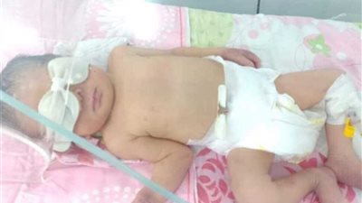 قبل بتر ذراعه..أول صورة للطفل 