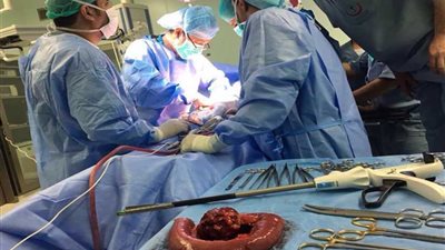 استئصال ورم وزنه 5ر3 كيلوجرام من سيدة بمستشفى كفر الشيخ الجامعي