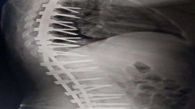 فريق طبي ينجح في إنهاء معاناة فتاة من تحدب وانحناء العمود الفقري