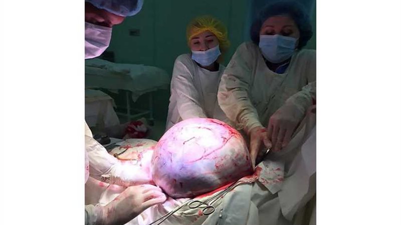 استئصال ورم يزن 25