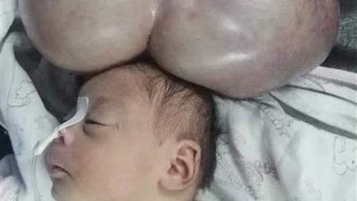 استئصال ورم يزن 5 كجم من رأس طفل عمره 3 أيام