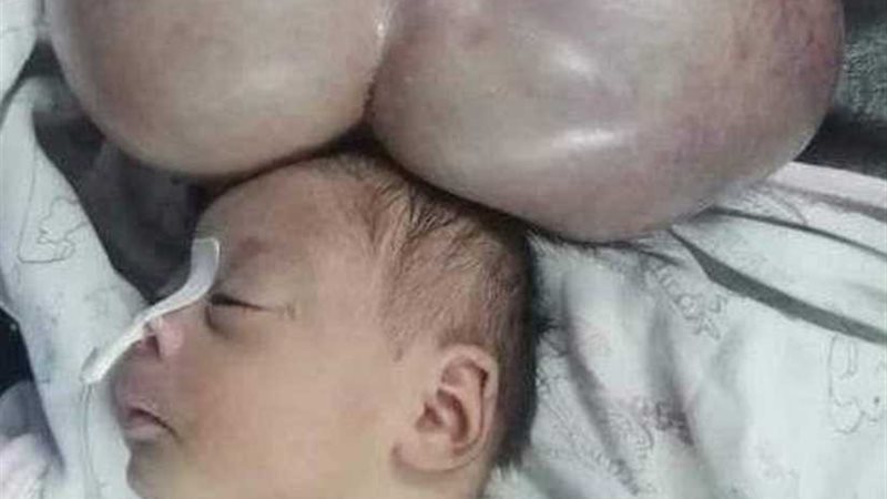 استئصال ورم يزن 5