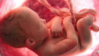 جنين في بطن أمه حالة نادرة… ولادة طفلة بـ7 أطراف