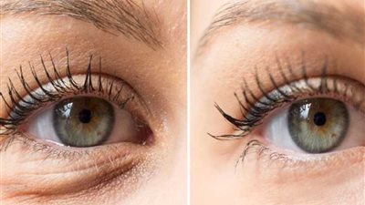 شد منتصف الوجه يستخدم لإستعادة شكل الجفن والخدين